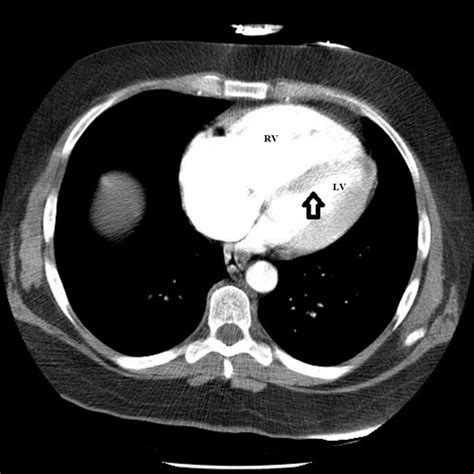 flattening of the interventricular septum